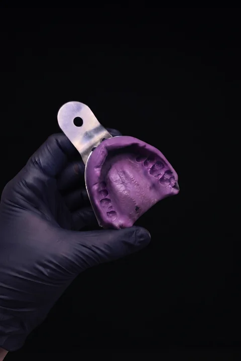 Cubeta de impresión con el molde de la dentadura, sostenida con guante negro